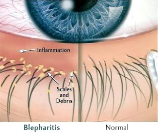 Seb-Blepharitis