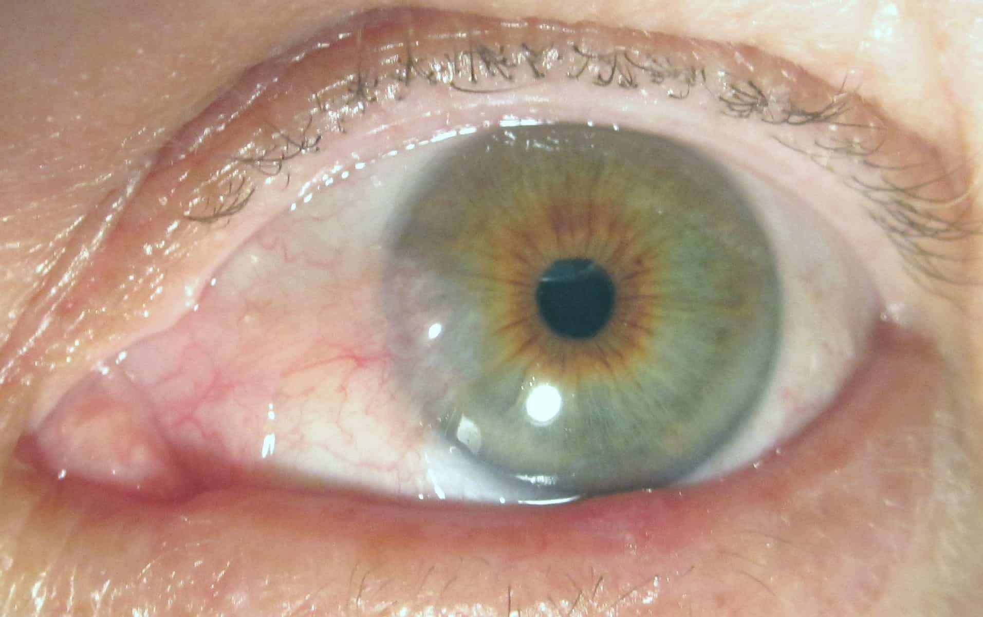 Pterygium Removal