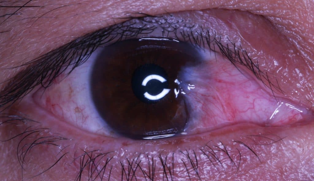 Pterygium Removal withI-BRITE® for Improved Confidence 