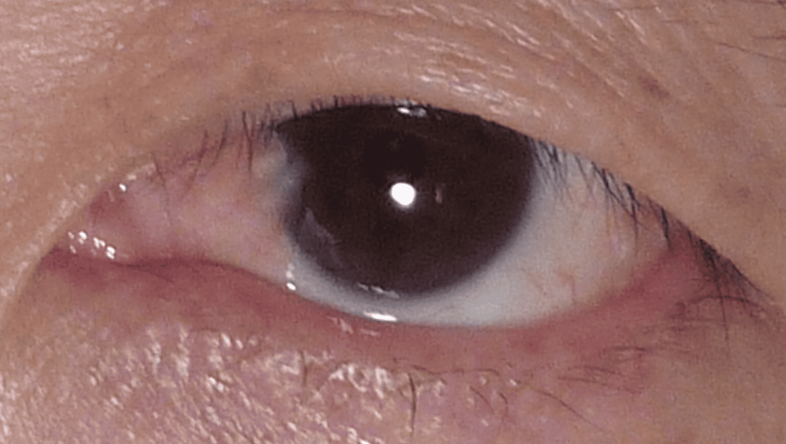 Pterygium Removal Los Angeles Boxer Wachler Vision Institute